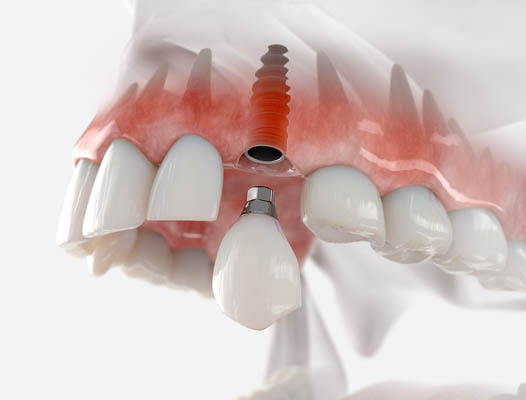 Dental Implants: Long Term Tooth Replacement Solution