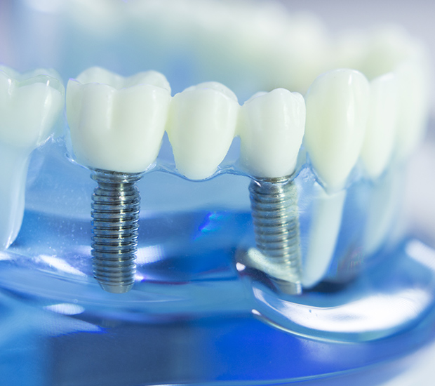 Elmhurst Dental Implants