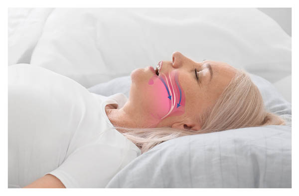 Questions And Answers About How A General Dentist Can Help With Sleep Apnea